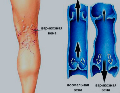 ФЛЕБОЛОГ